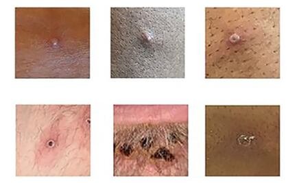 Viruela del mono no tarda en ser declarada pandemia, advierte experto de la OMS