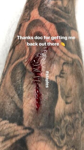 Aaron Ramsey muestra su herida en redes sociales