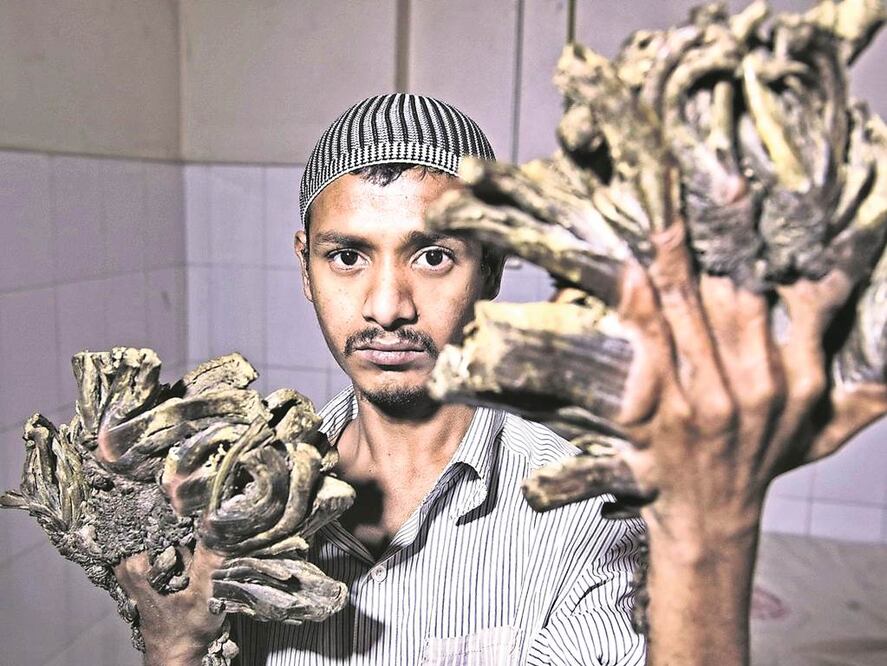 La enfermedad del hombre árbol