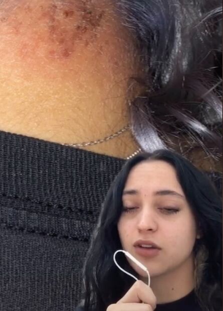 Mujer se pinta el pelo y le causa alergia: mira lo que pasó