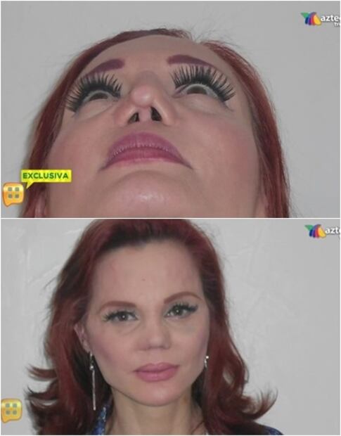 Carmen Campuzano se sometió a reconstrucción nasal