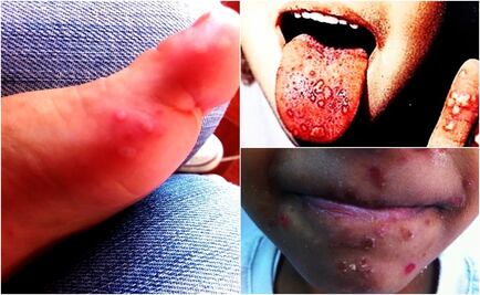 Entérate. ¿Qué es el virus coxsackie?