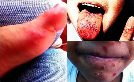 Entérate. ¿Qué es el virus coxsackie?