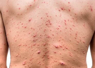 Registran nuevo caso de viruela símica en Morelos; suman 17 confirmados