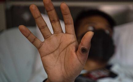 Cuba confirma su primer caso de viruela del mono