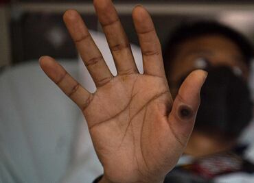 Cuba confirma su primer caso de viruela del mono