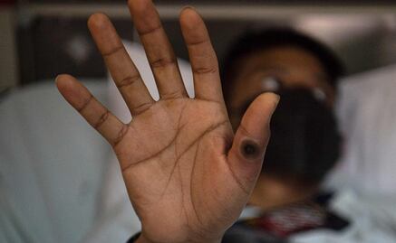 Cuba confirma su primer caso de viruela del mono