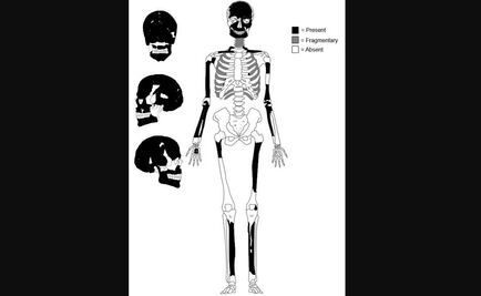 Hallan el primer caso de cáncer de hueso en Centroamérica