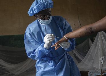 OMS mantiene el nivel más alto de alerta por la epidemia de mpox; los casos siguen aumentando