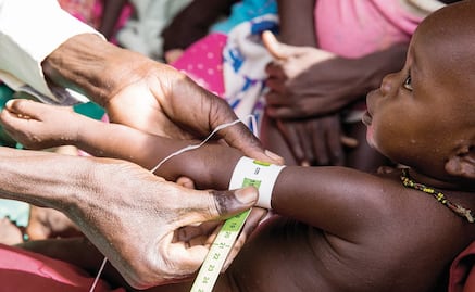 Qué es el Síndrome de Kwashiorkor y cuál es su relación con el Covid-19