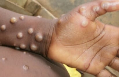 Los 15  turistas sinaloenses que estuvieron en fiesta de Puerto Vallarta no presentan síntomas de viruela del mono: Salud estatal 