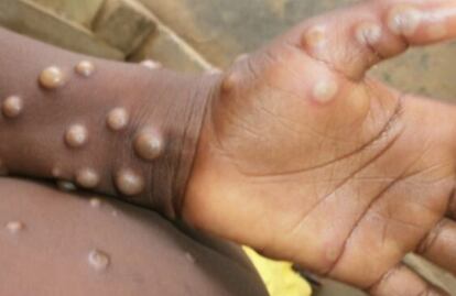 Los 15  turistas sinaloenses que estuvieron en fiesta de Puerto Vallarta no presentan síntomas de viruela del mono: Salud estatal 