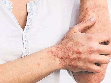 México confirma 147 casos de viruela del mono