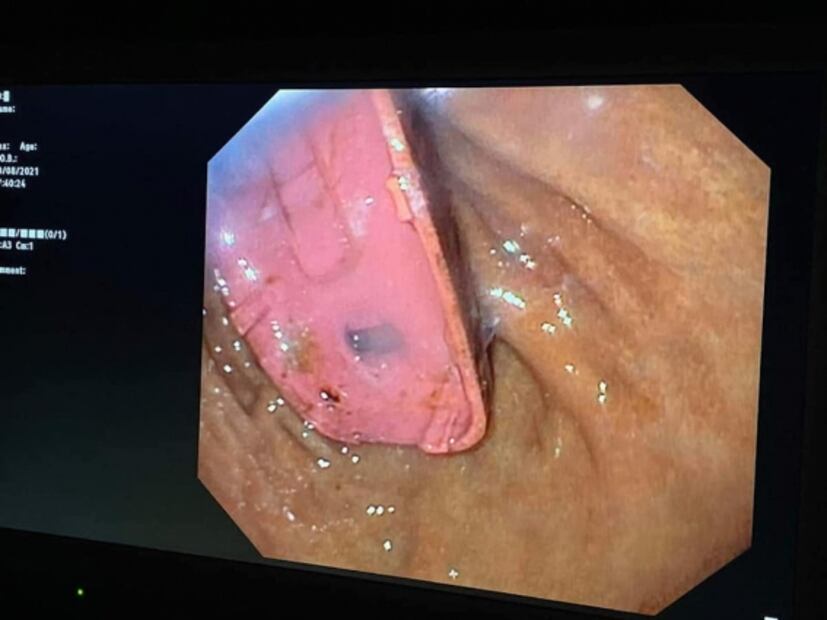 Viral: Hombre se traga un Nokia 3310 y termina en el hospital