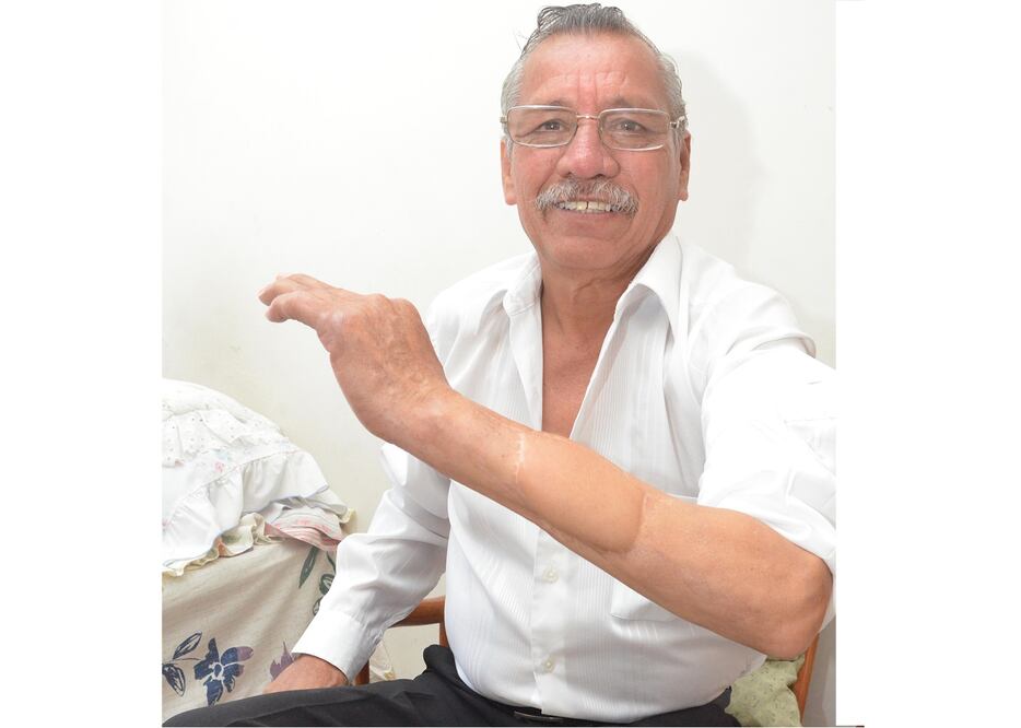 La intervención quirúrgica de Reynaldo Reynaldo tardó 10 horas, pues los médicos tuvieron que unir vasos, venas, arterias, tendones, nervios y los huesos rotos.