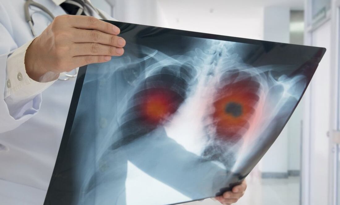 La inteligencia artificial podría aumentar la detección de cáncer en un 5%. Foto: BBC