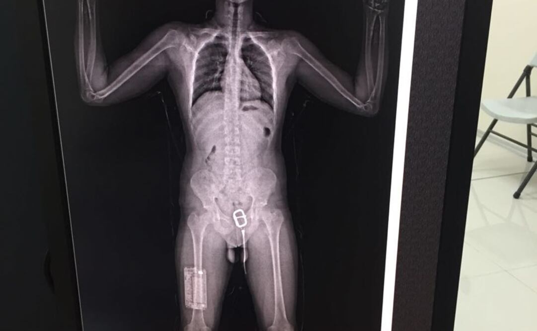 Imagen del escaneo al cuerpo del turista mexicano en la que se aprecian piezas extrañas en una rodilla y cerca de los genitales en las que se hallaron dólares. (Fotografía cortesía del Ministerio de Seguridad Pública de Costa Rica)