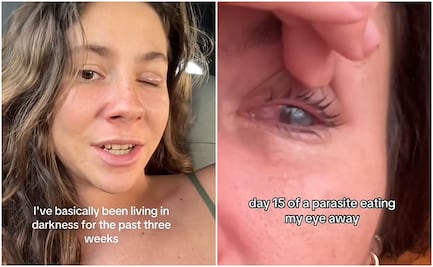VIDEO: extranjera cuenta cómo fue que un parásito devoró la córnea de su ojo mientras vivía en México