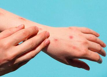 Viruela del mono puede provocar problemas en el corazón