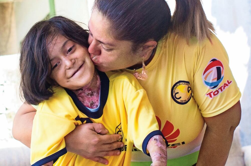 María Pura Porras Gómez será operada en el Hospital Universitario de Nuevo León para reconstruirle su mano derecha en noviembre próximo (ROBERTO AGUILAR)