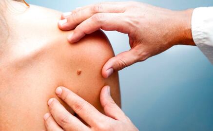Científicos desarrollan plataforma para detectar cáncer de piel