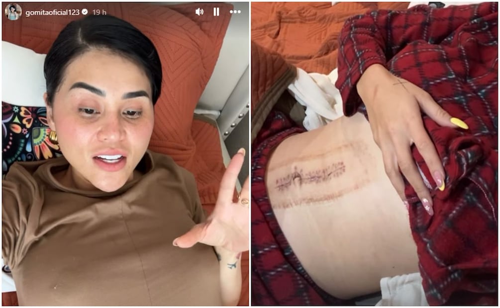Gomita muestra la cicatriz tras cirugía que le salvó la vida.