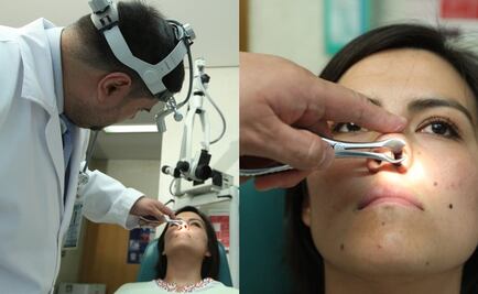 IMSS atendió a más de 600 por tumor maligno de fosa nasal