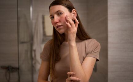 Descubre la mejor vitamina para el acné