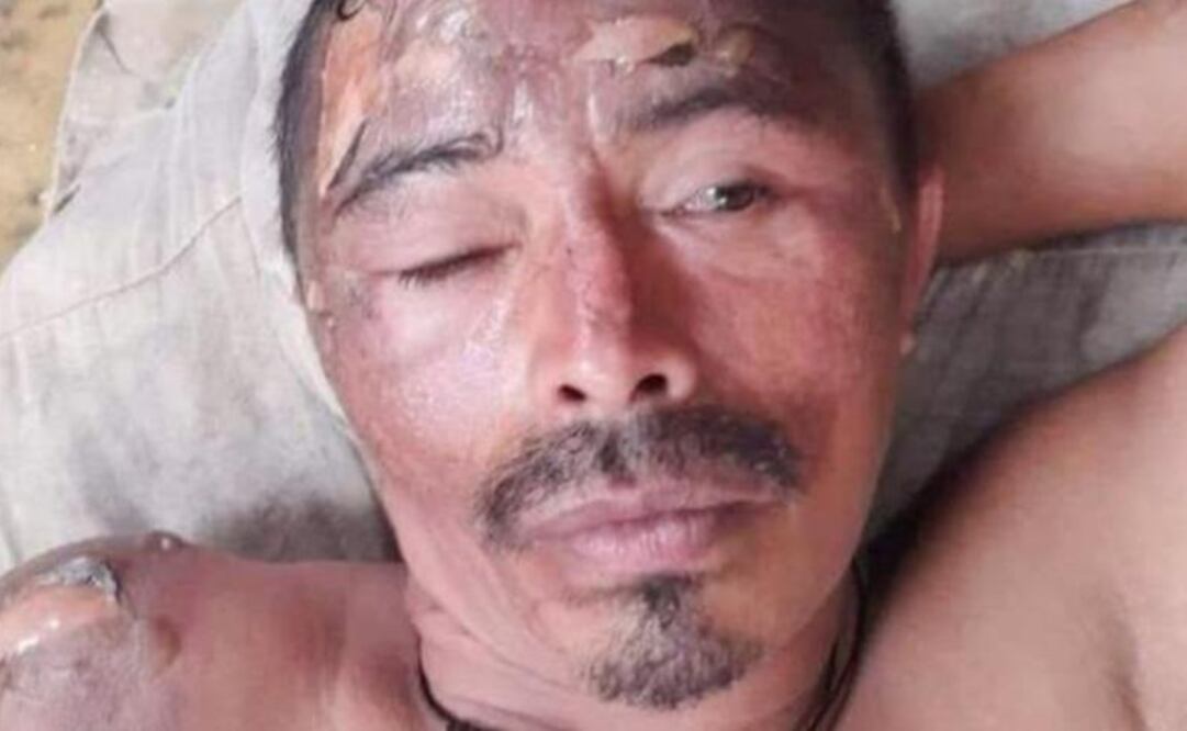 Habitante de calle herido en Sincelejo. Foto: El Tiempo