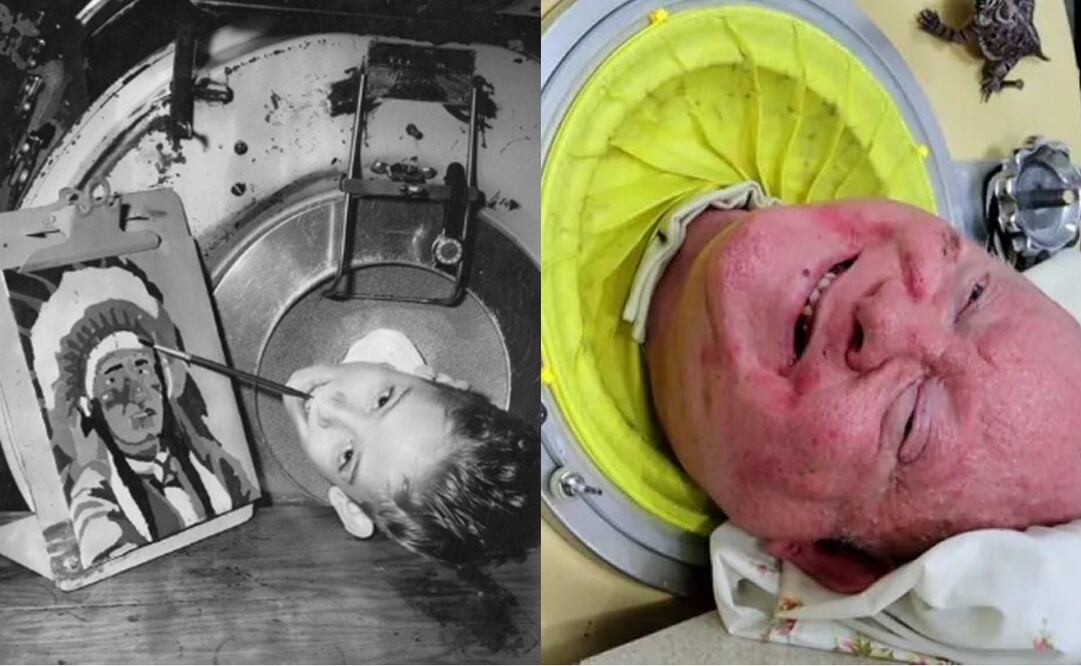 Fallece Paul Alexander, hombre que vivió 70 años de su vida dentro dentro de un pulmón de acero. FOTO: Especial