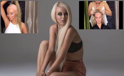 Modelo australiana muestra su lucha contra la alopecia