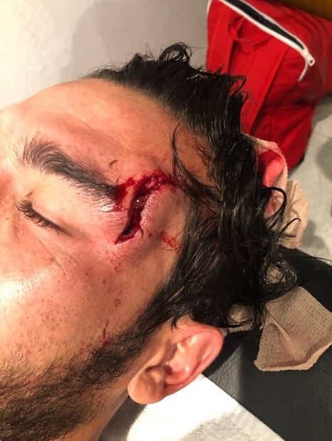 Las peores heridas por arteras entradas en el futbol