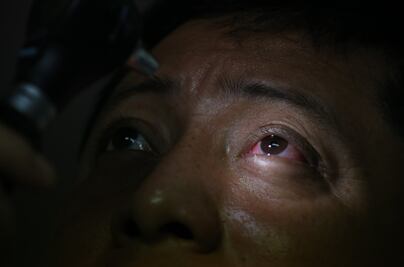 Un fármaco mejora la esperanza de vida en pacientes con cáncer de ojo agresivo