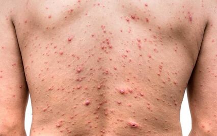 EU distribuirá un millón de dosis de la vacuna contra la viruela del mono