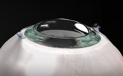 Le implantan córnea sintética y recupera la vista 