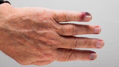 Septicemia, la enfermedad que mata a más personas que el cáncer