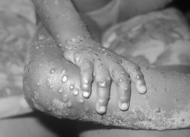 OMS preocupada por una nueva cepa de la "viruela del mono"