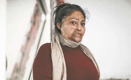 Un ataque con ácido derritió su piel