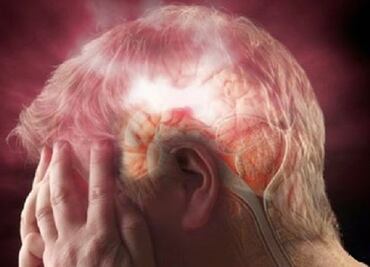 Una de cada tres personas podría sufrir un "mini derrame" cerebral sin saberlo