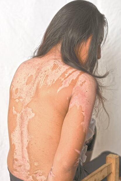 Agresor la quemó con agua; "no es delito", le dijeron en el MP