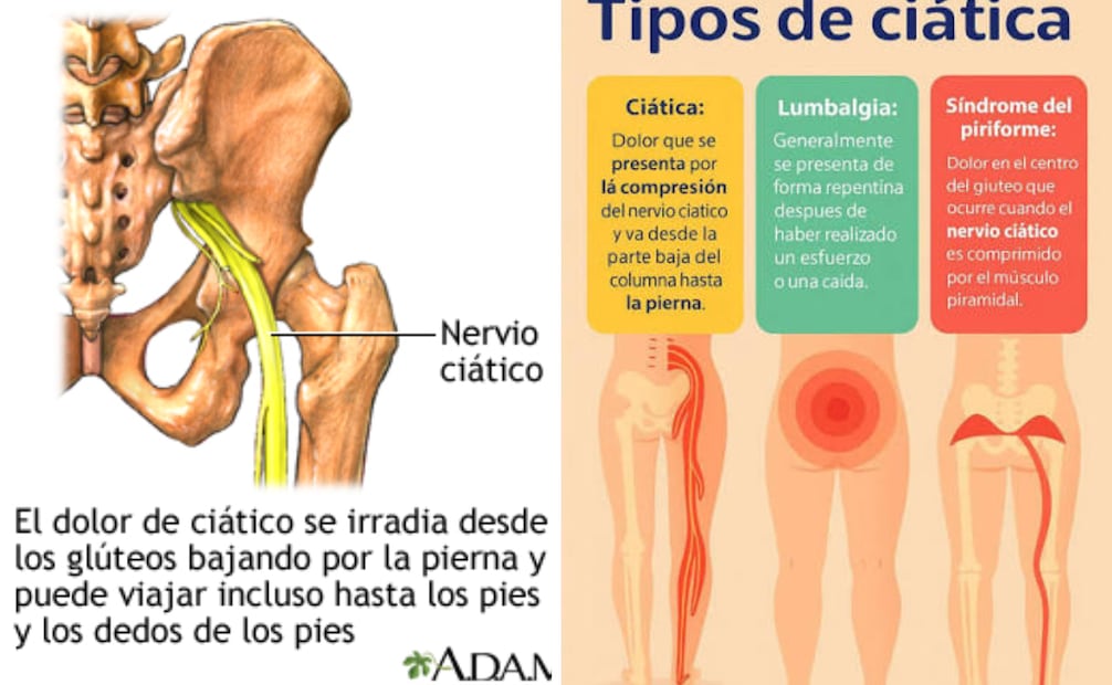 Foto: Captura de pantalla en página MedlinePlus