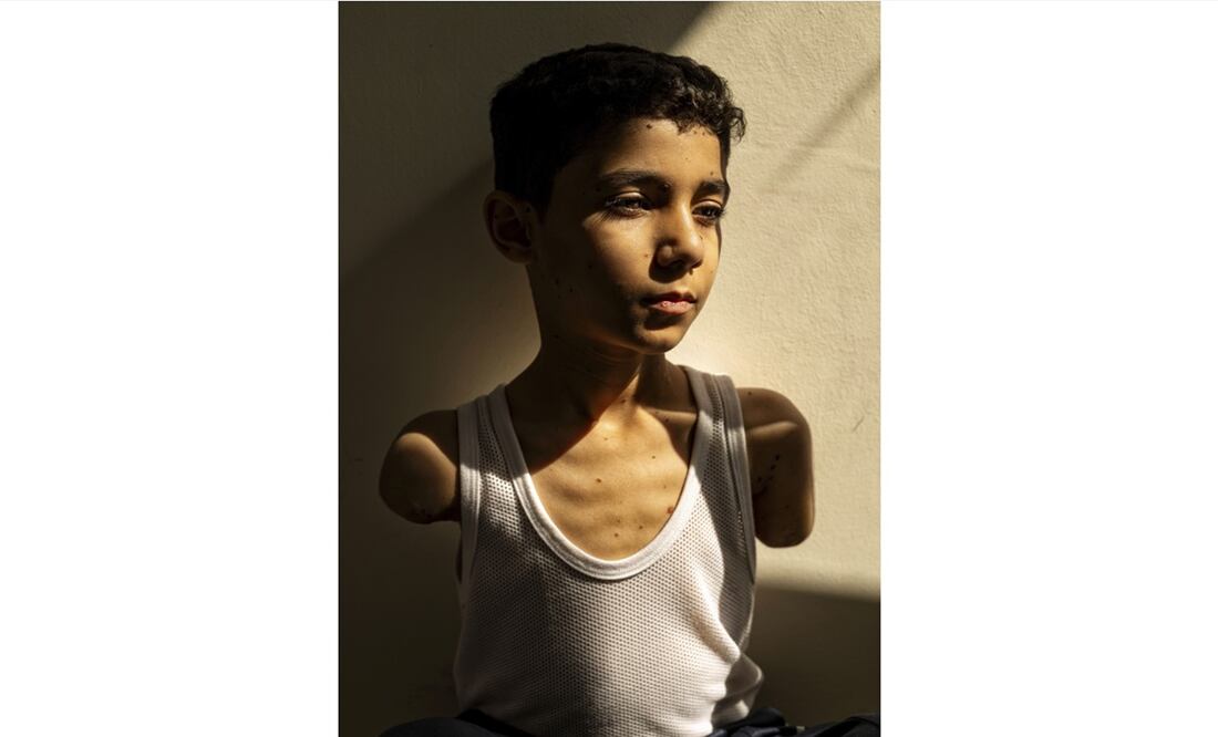 Imagen de un niño palestino de nueve años, que perdió sus dos brazos cuando huía de un ataque israelí en Gaza, ganó el  primer premio del World Press Photo 2025, el jueves 17 de abril de 2025. Foto: AP