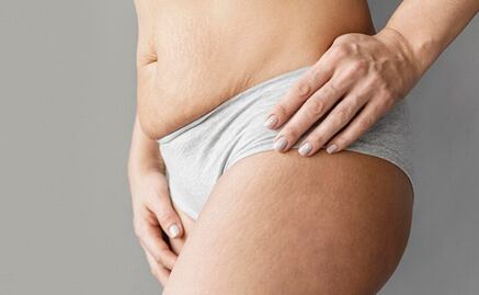 La vitamina que te ayudará a eliminar estrías blancas en la piel