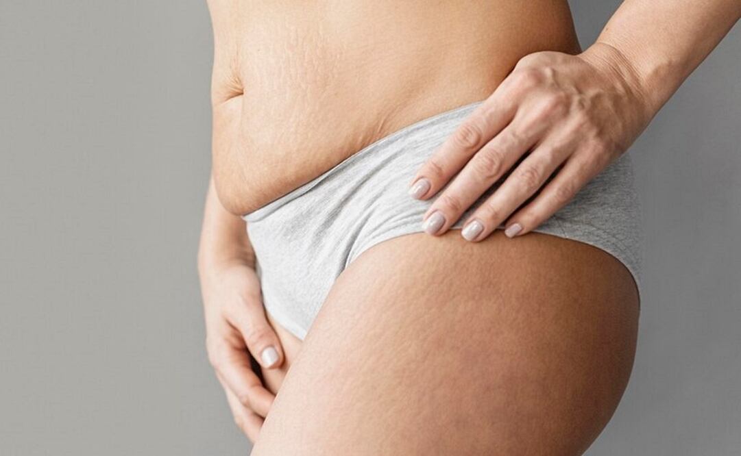 Tener estrías blancas es normal. Foto: Freepik