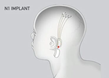 Elon Musk busca reproducir música en tu cerebro con Neuralink