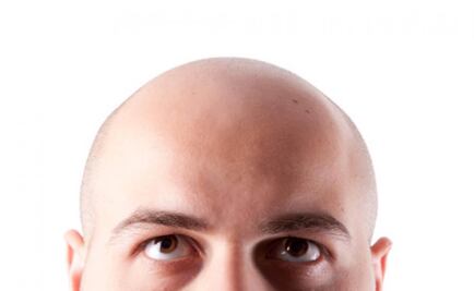 La calvicie no tiene cura y afecta a 50% de los jóvenes mexicanos 