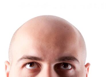 La calvicie no tiene cura y afecta a 50% de los jóvenes mexicanos