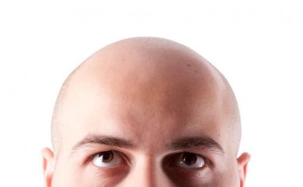 La calvicie no tiene cura y afecta a 50% de los jóvenes mexicanos 
