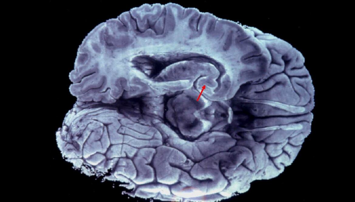 Muestras de lesiones histopatológicas, características de la enfermedad de Alzheimer, en una porción inferior del cerebro. Foto: Cortesía del Cinvestav, archivo 