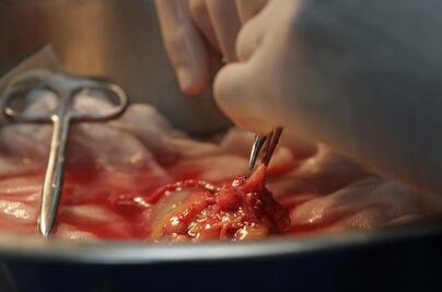 La insuficiencia renal es una de las principales enfermedades en México, especialistas 